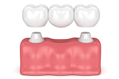 dental crowns benefits