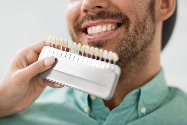 How long do Dental Veneers last? Maryborough Dental
